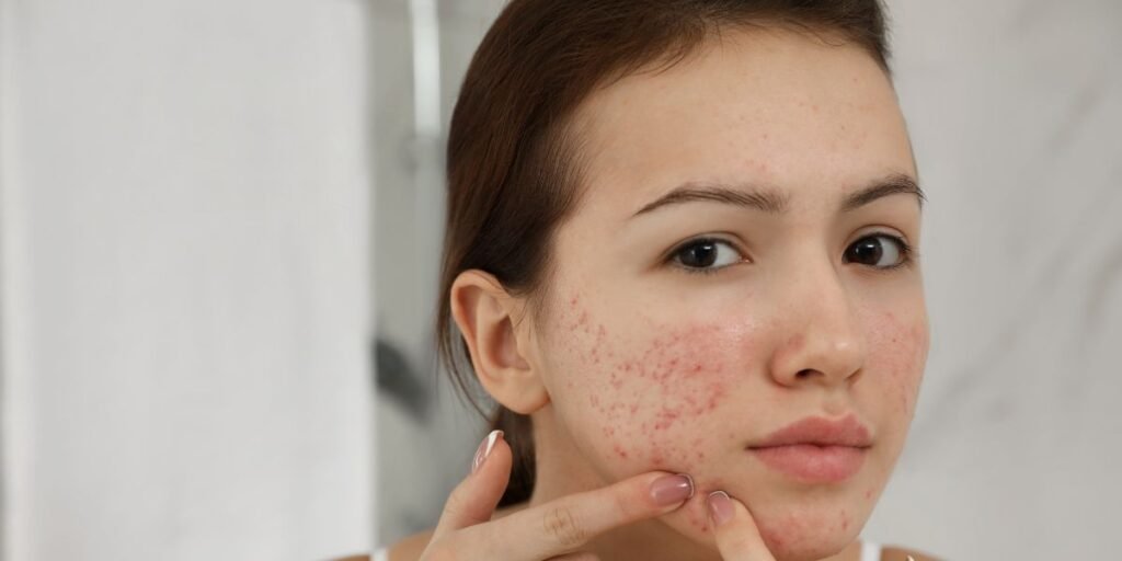 How to Treat Acne Scars and Prevent New Breakouts